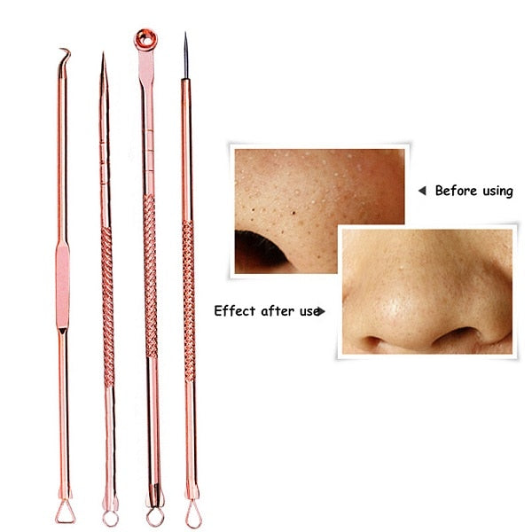 4Pcs/Set Rose Gold Acne Kit