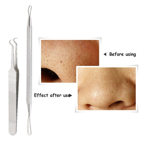 4Pcs/Set Rose Gold Acne Kit